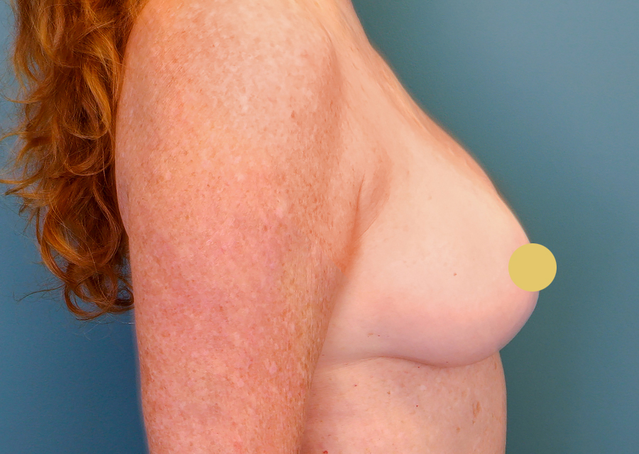 Breast Augmentation After Photo