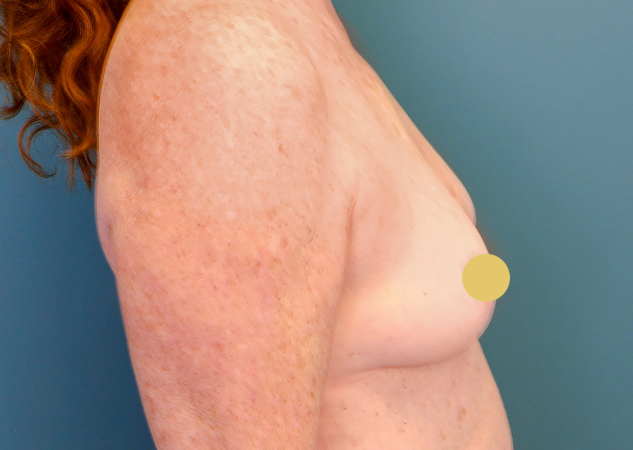 Breast Augmentation Before Photo