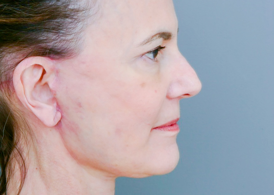 Facelift After Photo