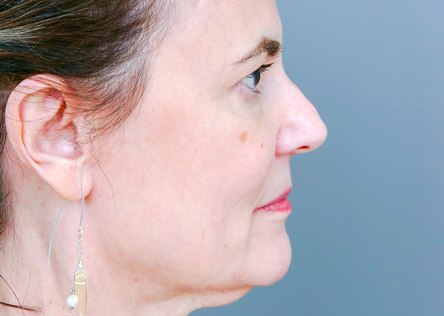 Facelift Before Photo