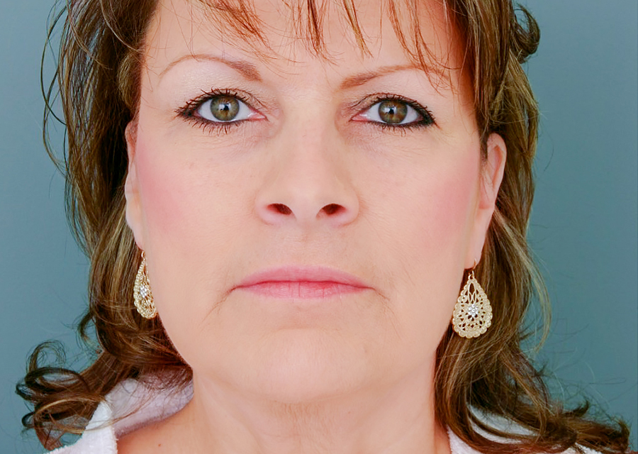 Facelift Before Photo