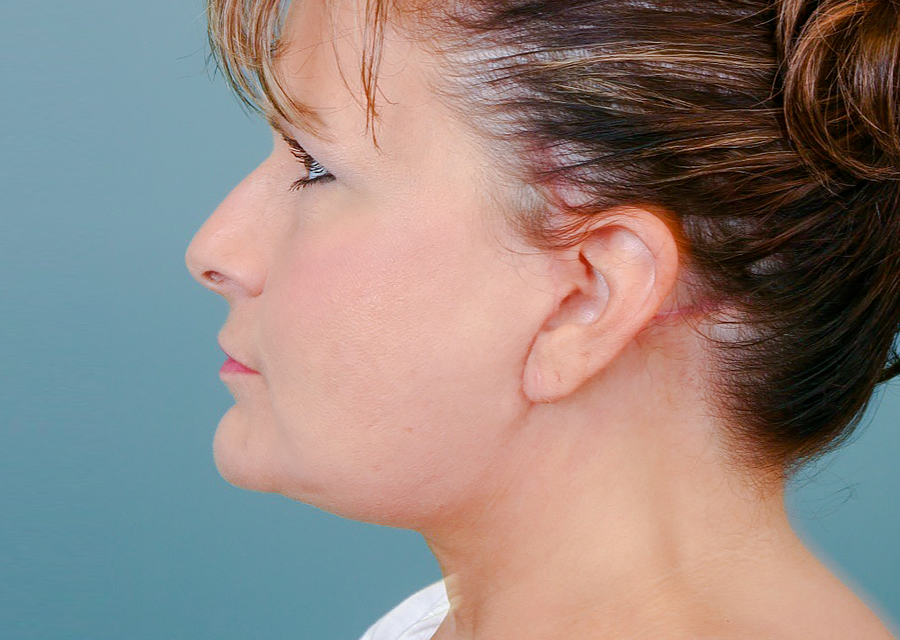 Facelift After Photo