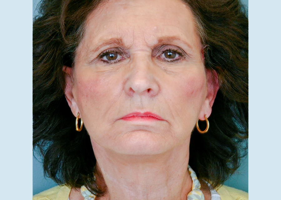 Facelift After Photo