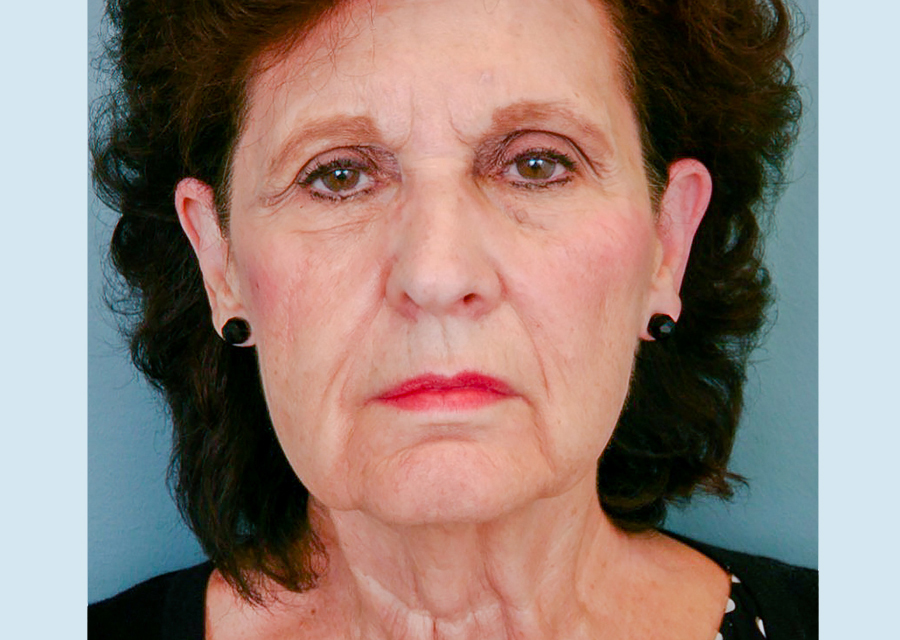 Facelift Before Photo