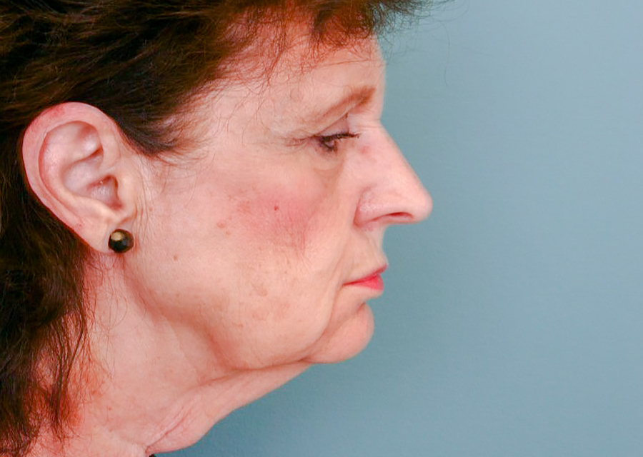 Facelift Before Photo