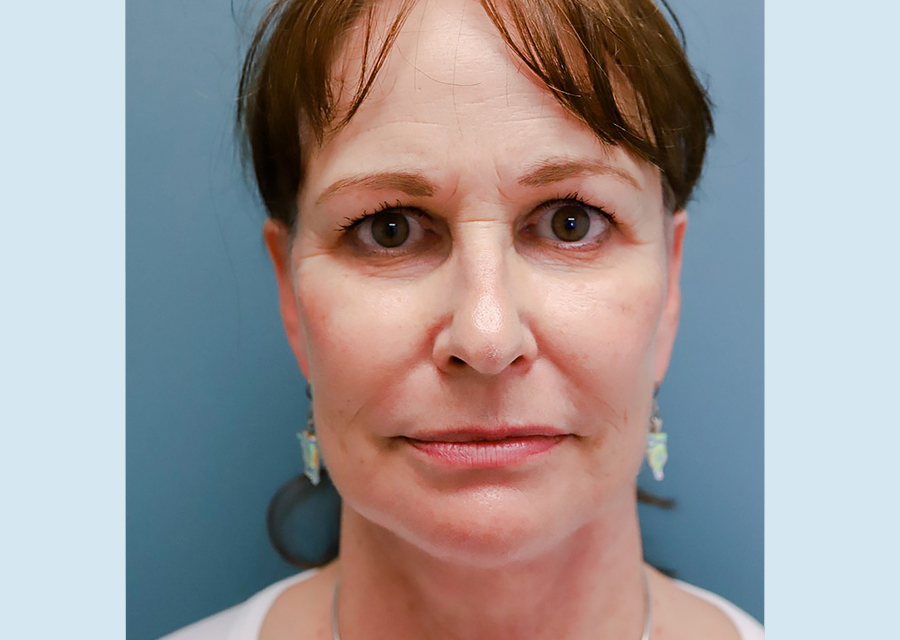 Facelift  After Photo