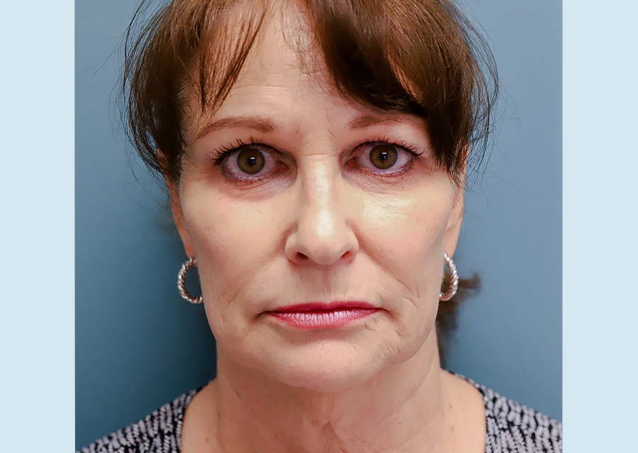 Facelift  Before Photo