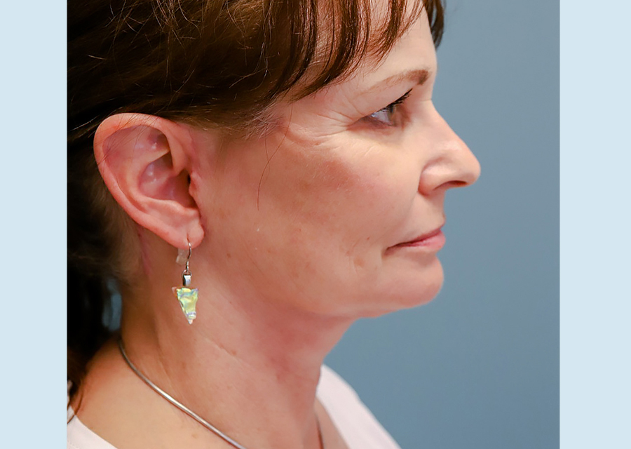 Facelift After Photo