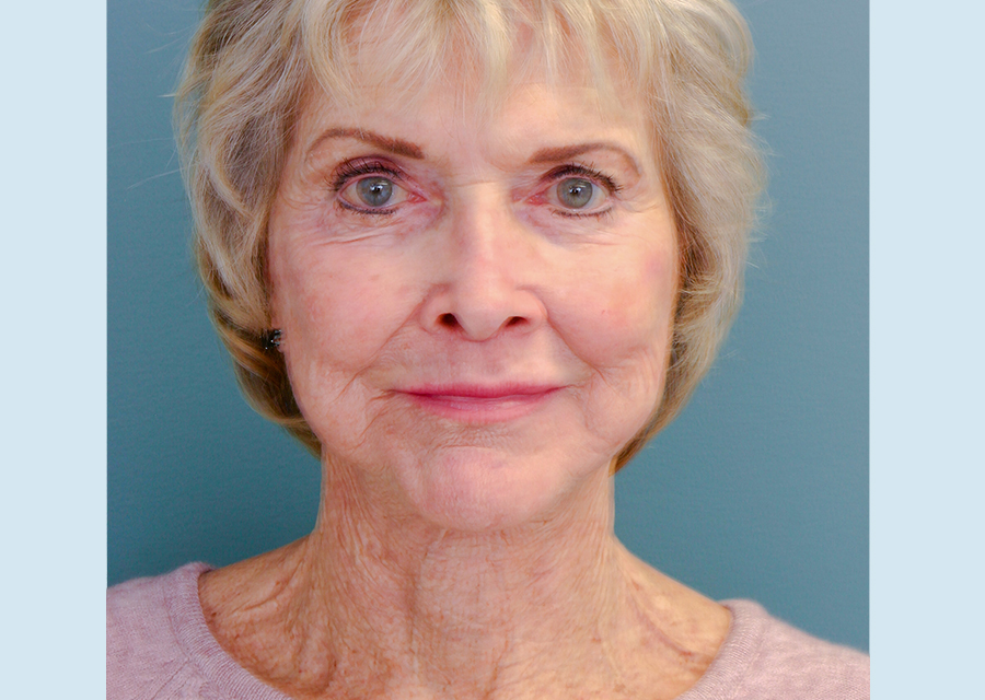 Facelift After Photo