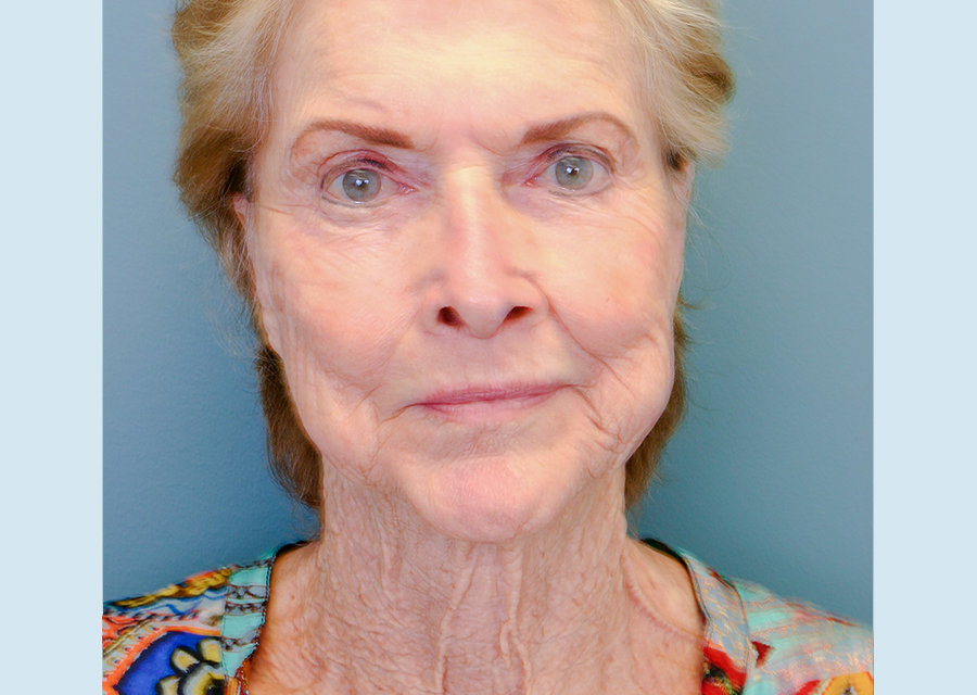 Facelift Before Photo