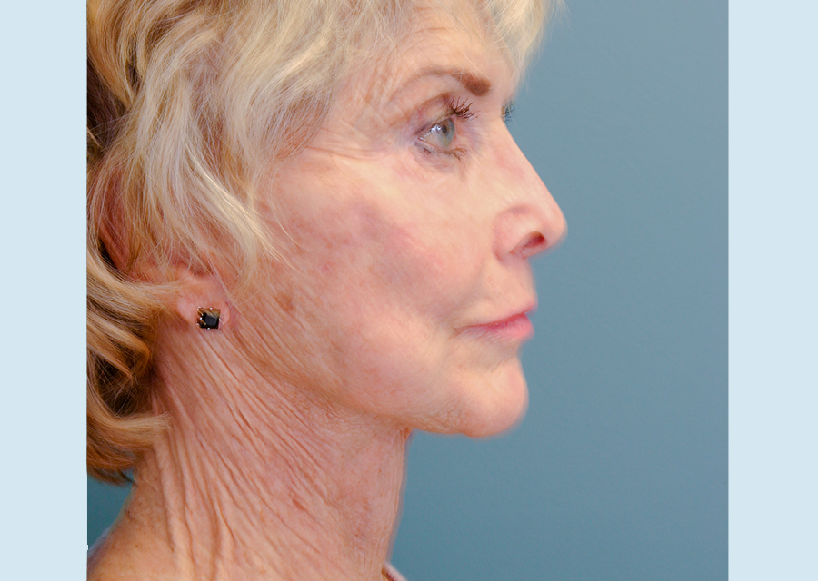 Facelift  After Photo