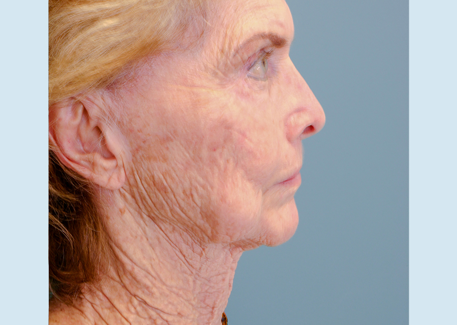 Facelift  Before Photo