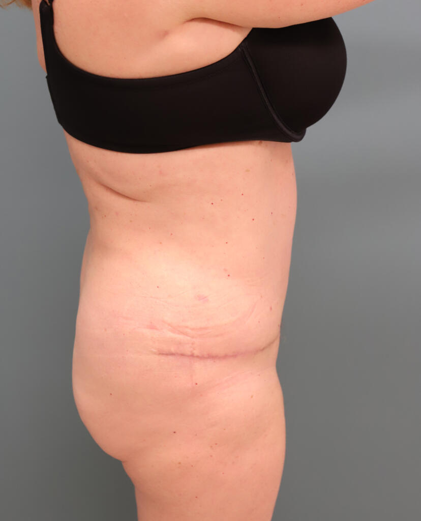 Reverse Abdominoplasty: Is It Right for You? - The Lucas Center