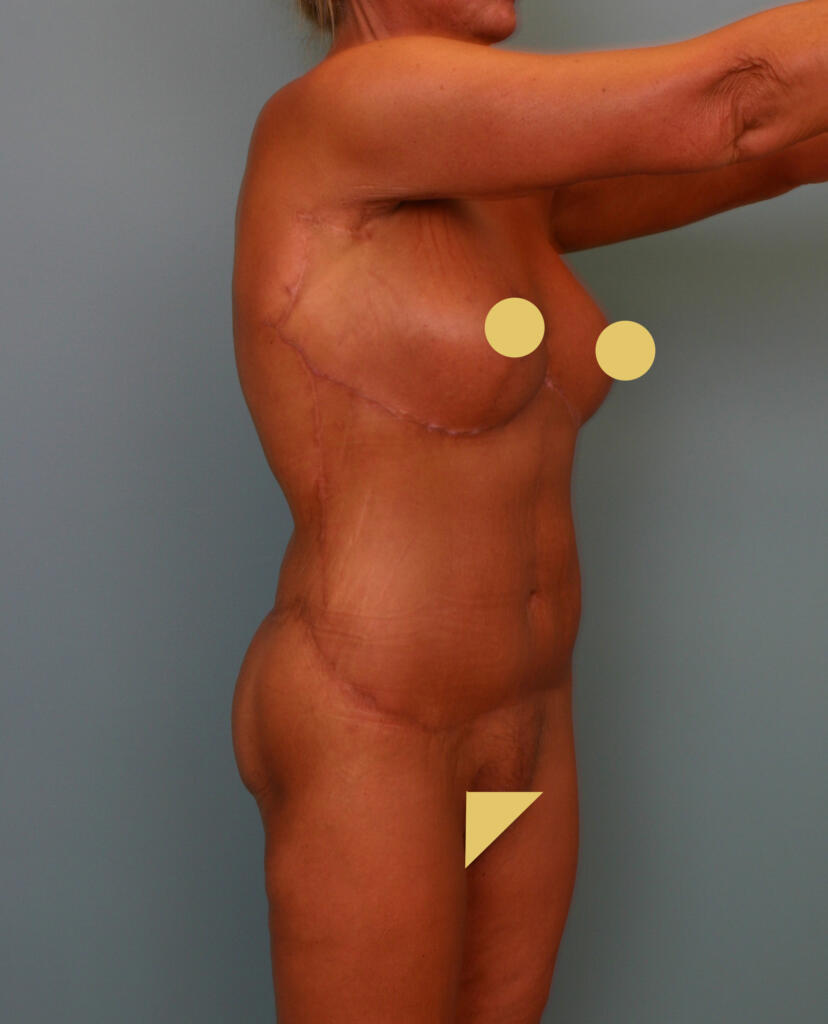 Circumferential Body Lift & Gluteal Enhancement After Photo