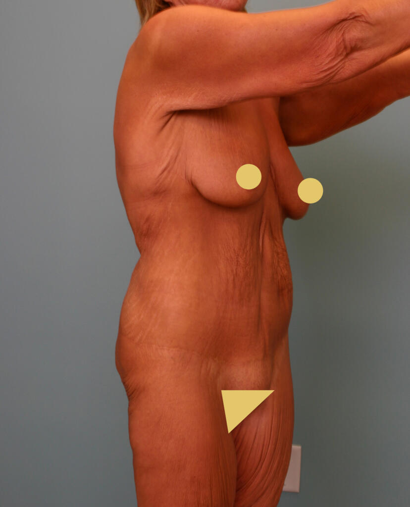 Circumferential Body Lift & Gluteal Enhancement Before Photo