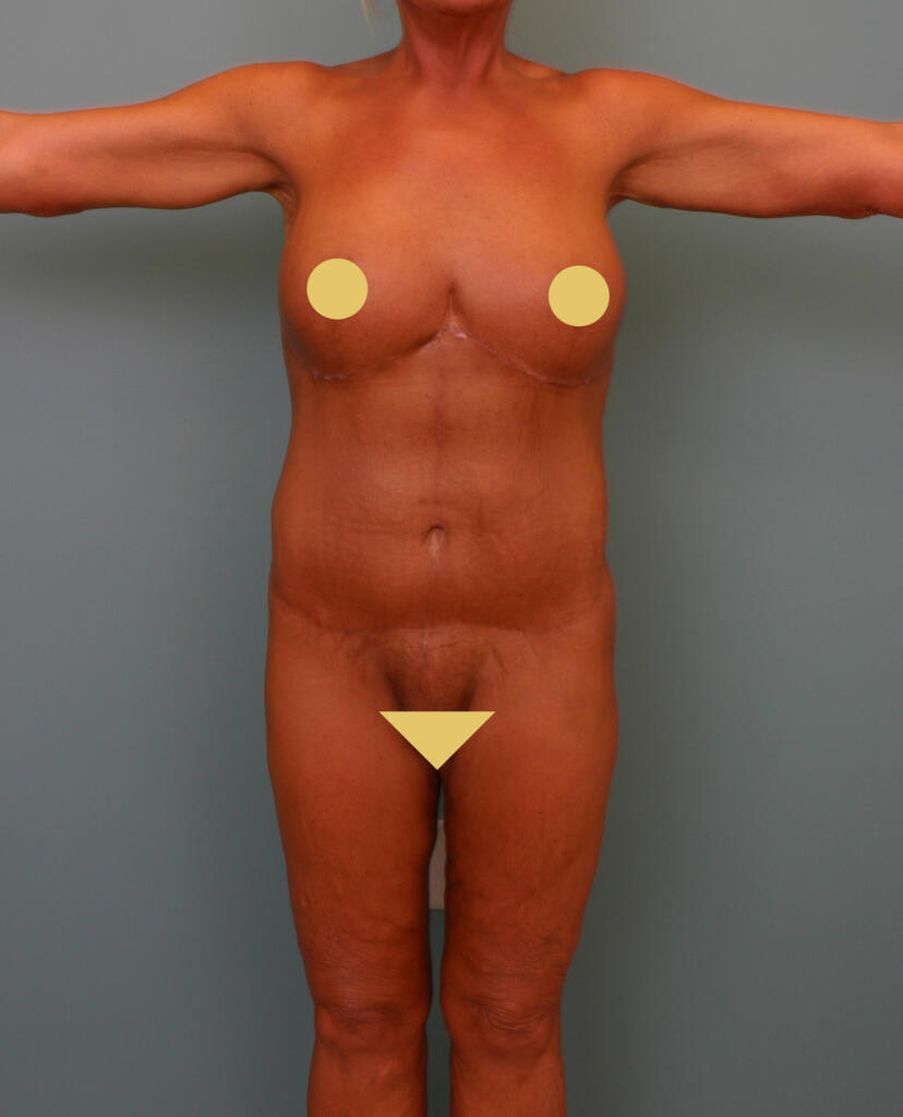 Circumferential Body Lift & Gluteal Enhancement After Photo