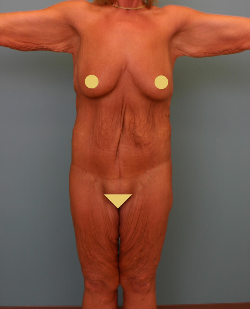 Circumferential Body Lift & Gluteal Enhancement Before Photo