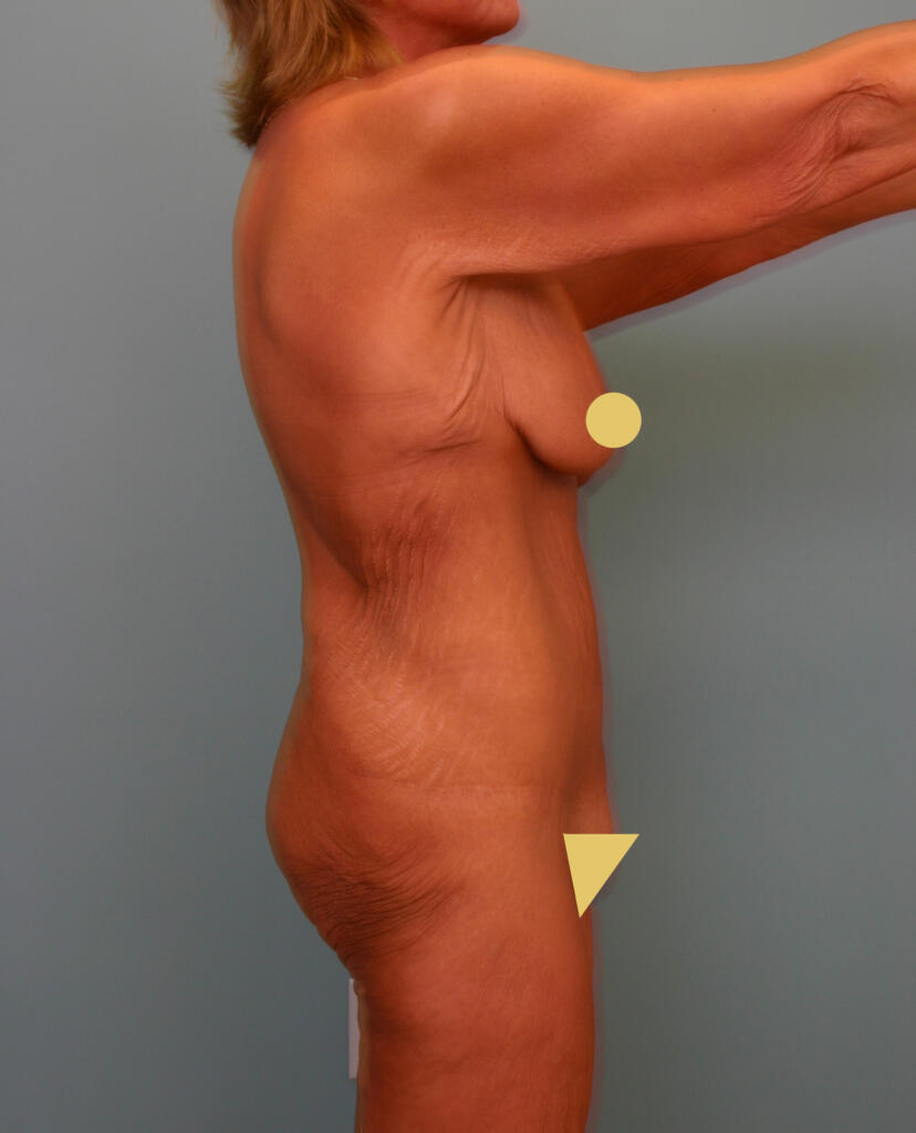 Circumferential Body Lift & Gluteal Enhancement Before Photo
