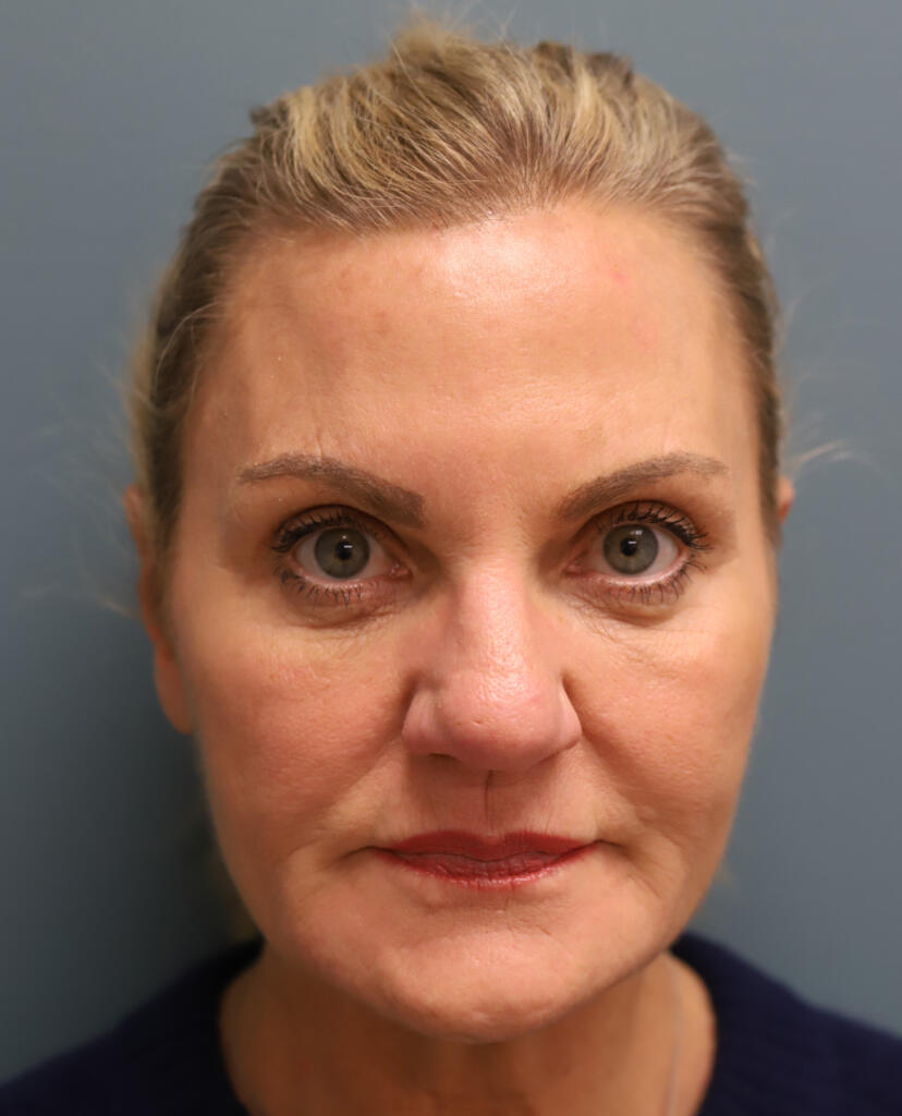 Facelift Before Photo