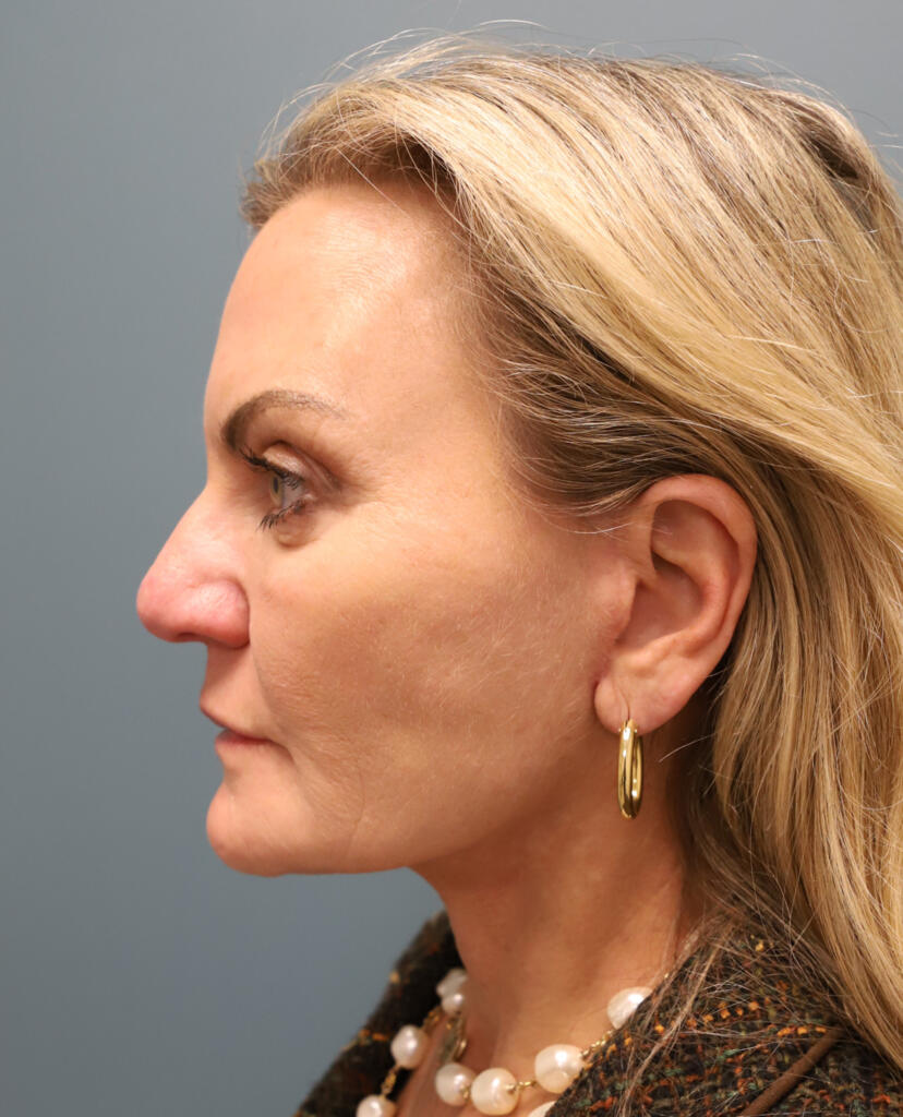 Facelift After Photo