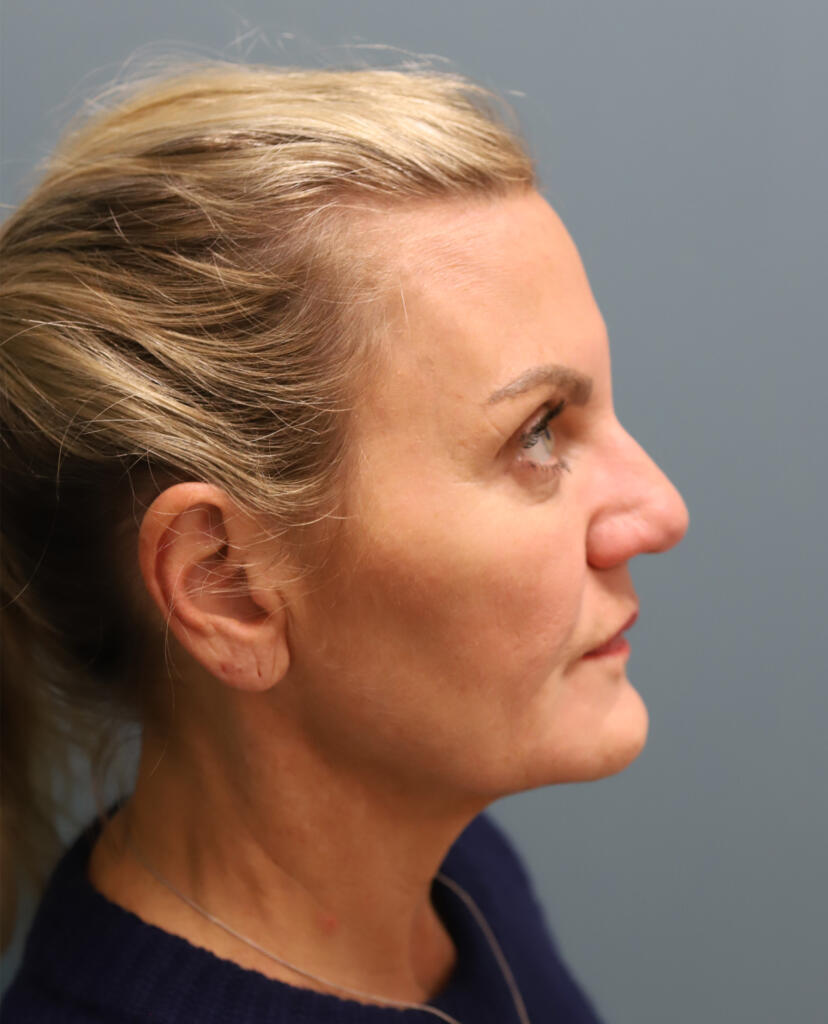 Facelift Before Photo