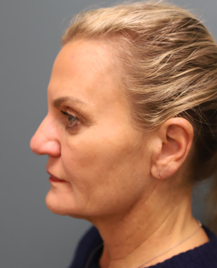 Facelift Before Photo