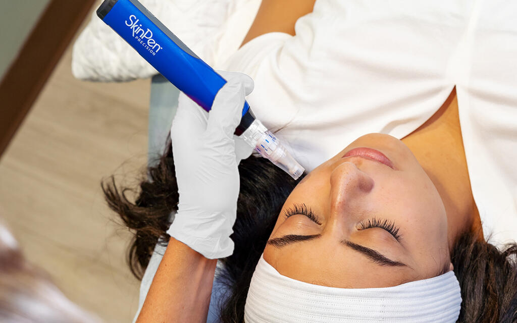 Woman undergoing microneedling procedure on face