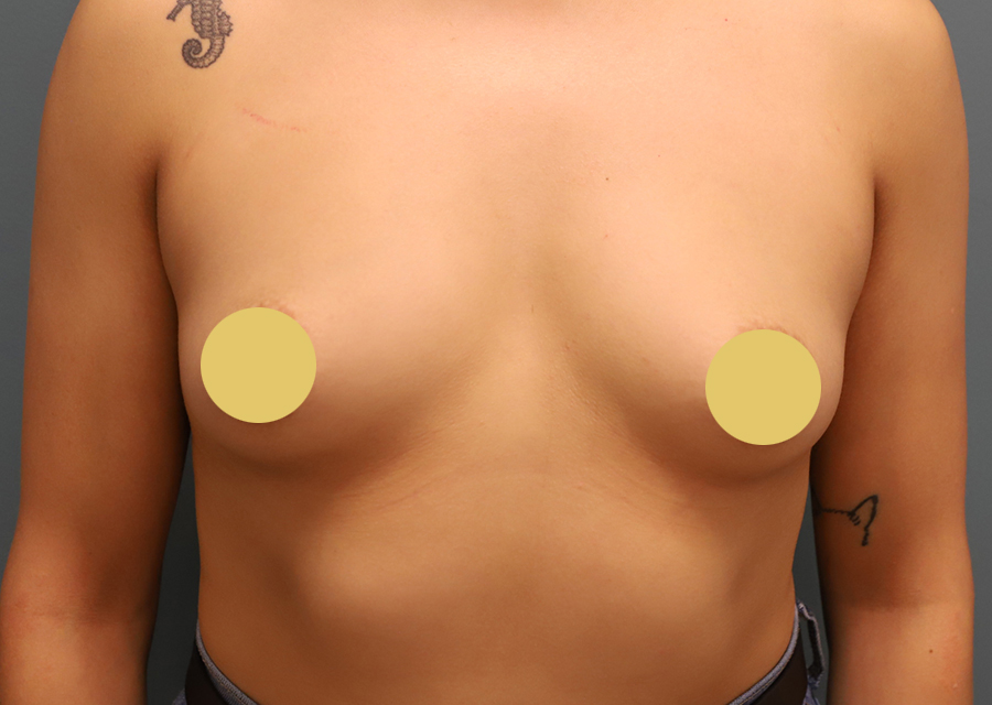 Breast Augmentation Before Photo