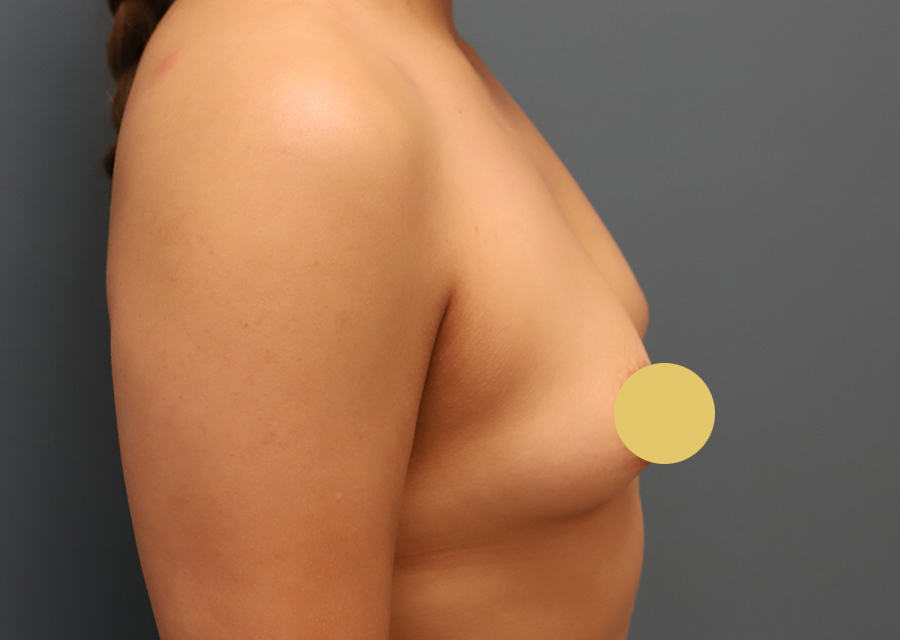 Breast Augmentation Before Photo