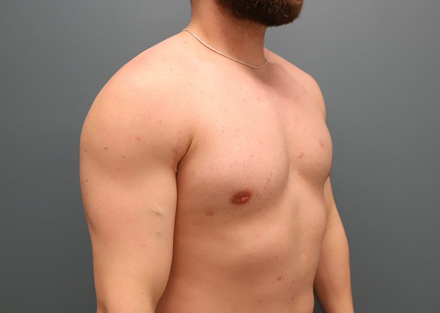 Gynecomastia After Photo