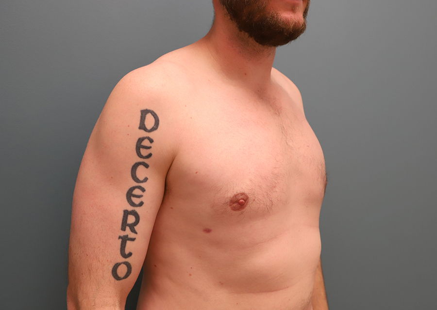 Gynecomastia After Photo