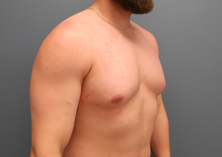 Gynecomastia Before Photo