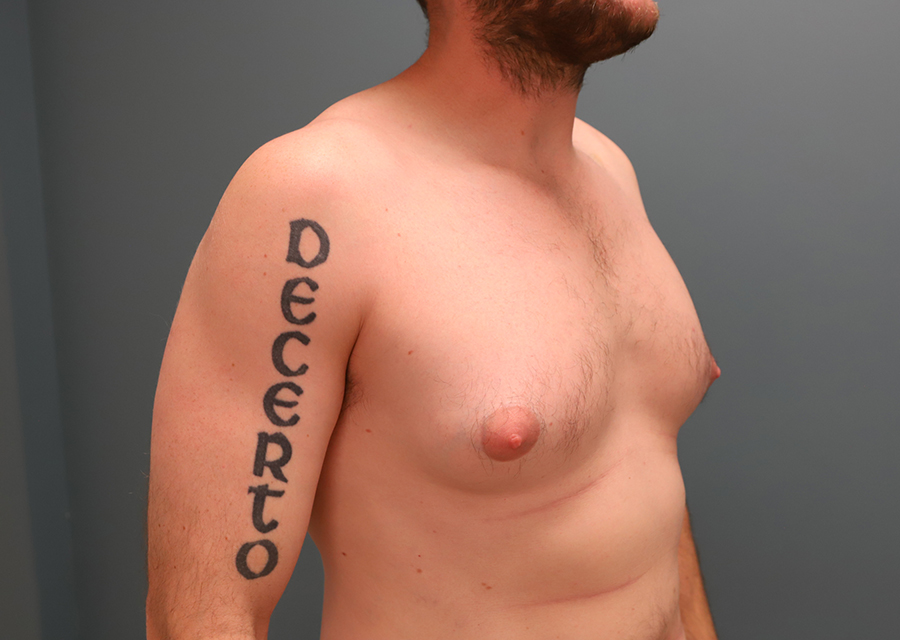 Gynecomastia Before Photo
