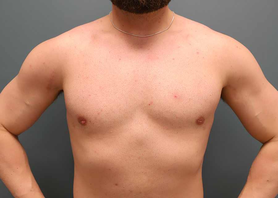Gynecomastia After Photo