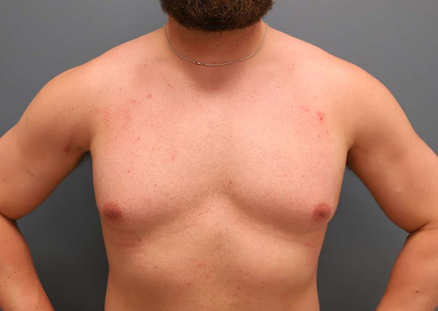 Gynecomastia Before Photo