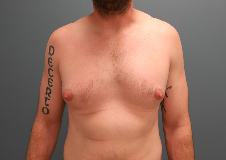 Gynecomastia Before Photo