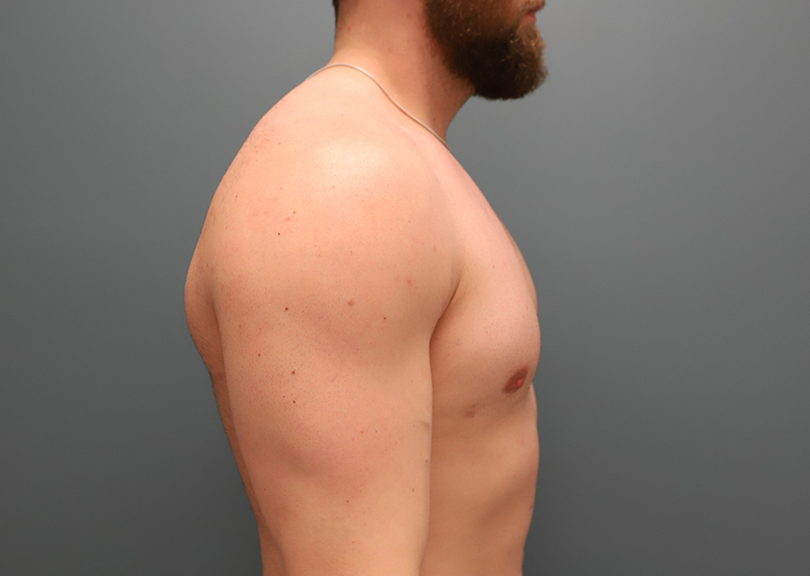 Gynecomastia After Photo
