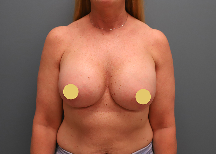 Breast Augmentation After Photo