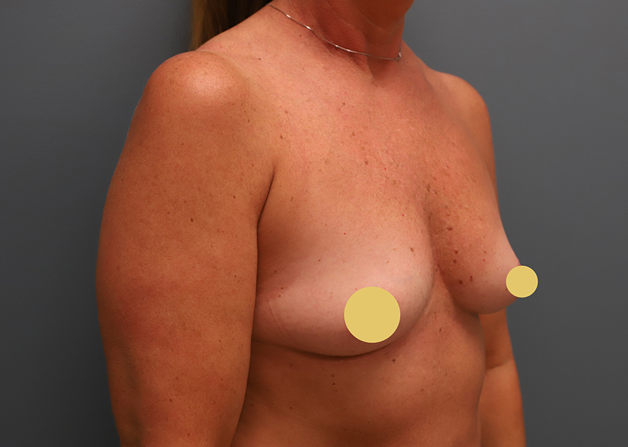 Breast Augmentation Before Photo