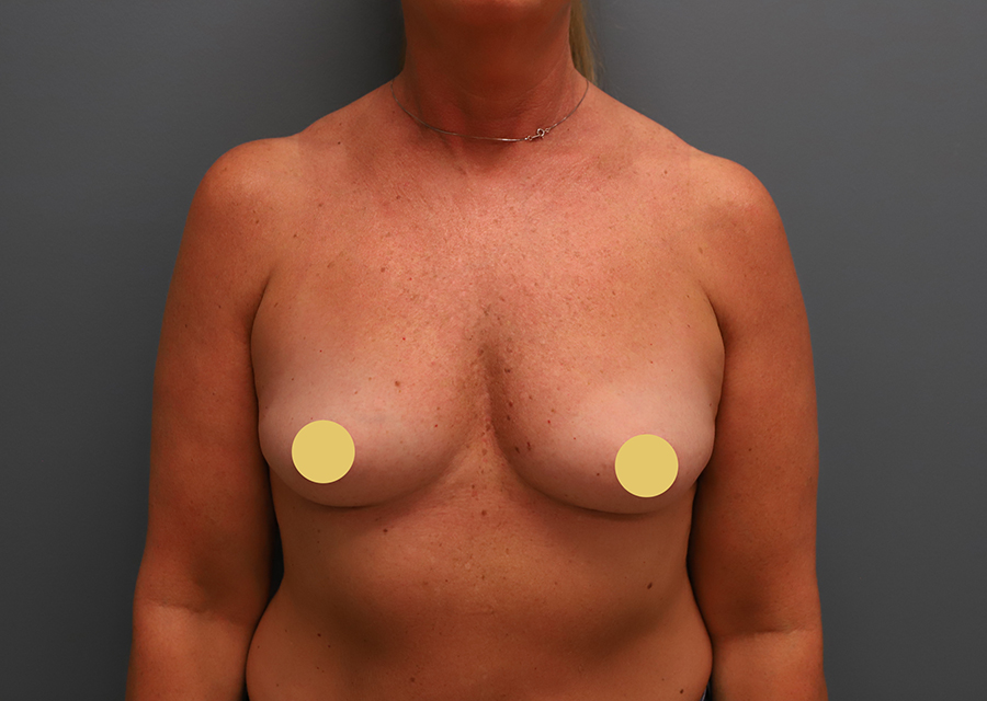 Breast Augmentation Before Photo