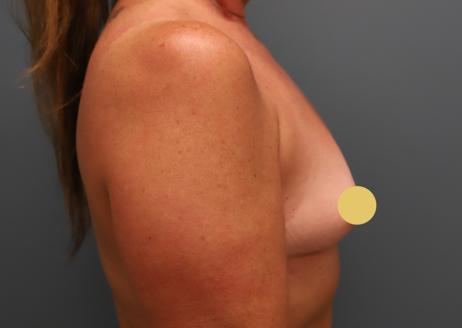 Breast Augmentation Before Photo