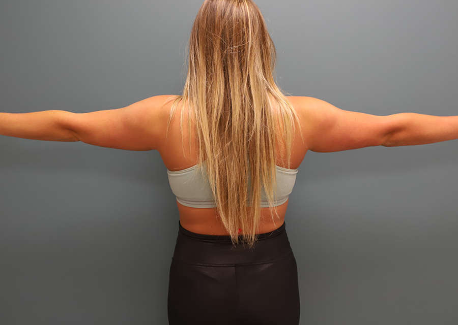 Brachioplasty Before Photo