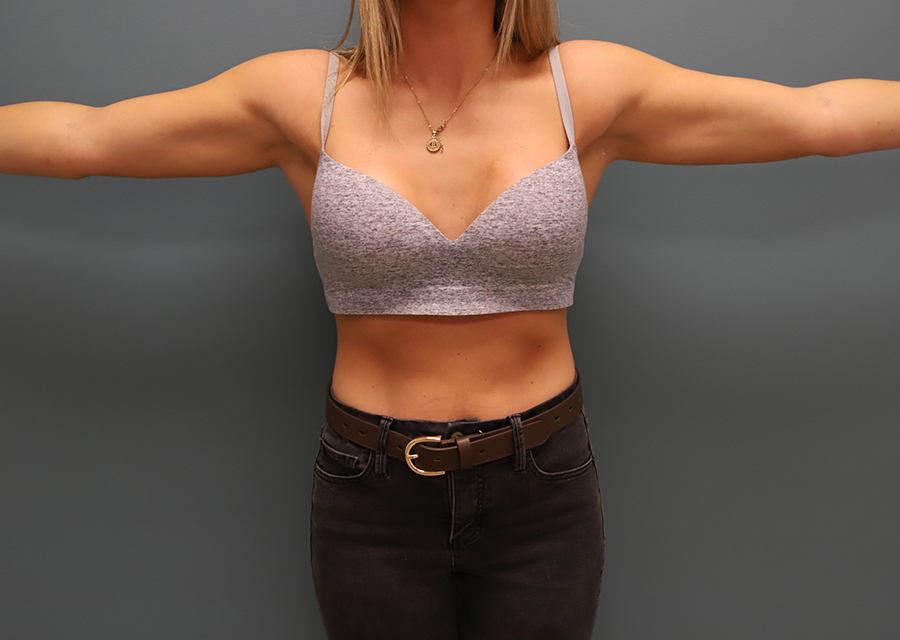Brachioplasty After Photo