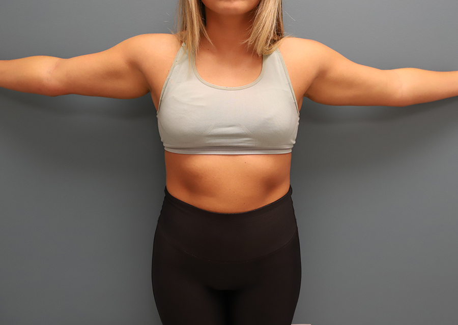 Brachioplasty Before Photo