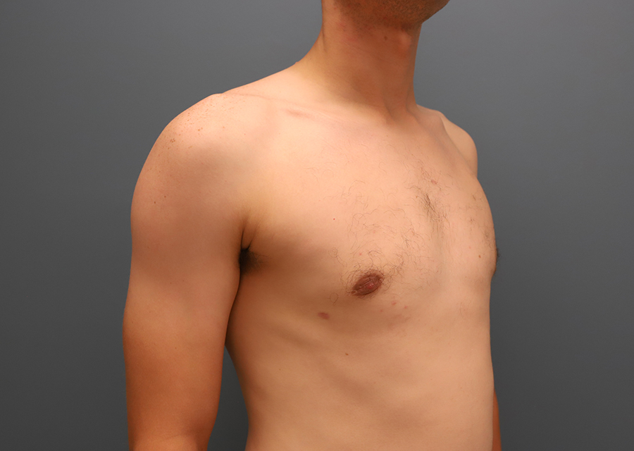 Male Chest Reduction After Photo