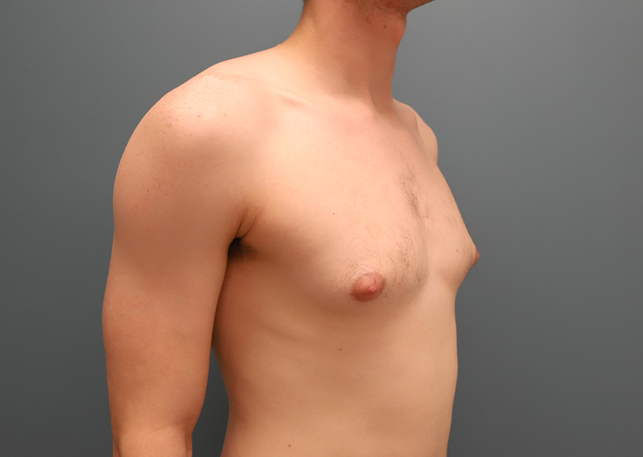 Male Chest Reduction Before Photo