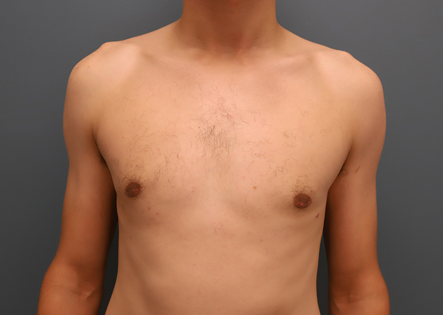 Male Chest Reduction After Photo