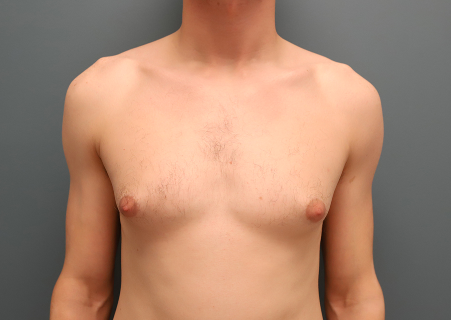 Male Chest Reduction Before Photo