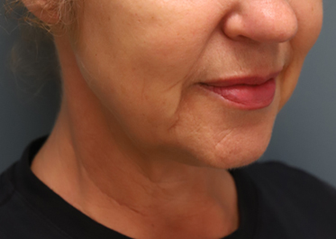 Ellacor Skin Rejuvenation Before Photo