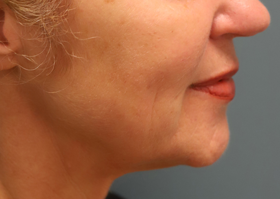 Ellacor Skin Rejuvenation After Photo